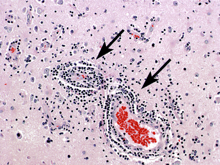 TSL-Lymphocytic-Vasculitis.gif